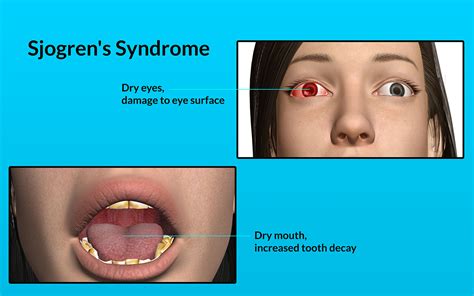 Sjogren's Syndrome|Causes|Risk Factors|Signs|Symptoms|Investigations ...