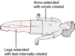 Decerebrate Posture : Cause, symptoms, Treatment, Exercise : Samarpan