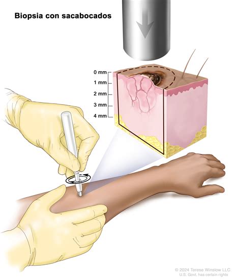 Definición de biopsia con sacabocados Diccionario de cáncer del NCI NCI