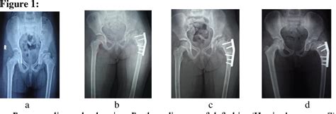 Table III From CLINICO RADIOLOGICAL EVALUATION OF LEGG CALVE PERTHES