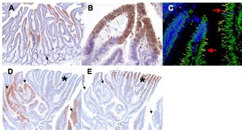 Aberrant Staining Pattern Of Lgr5 In Colonic Adenoma A Patchy