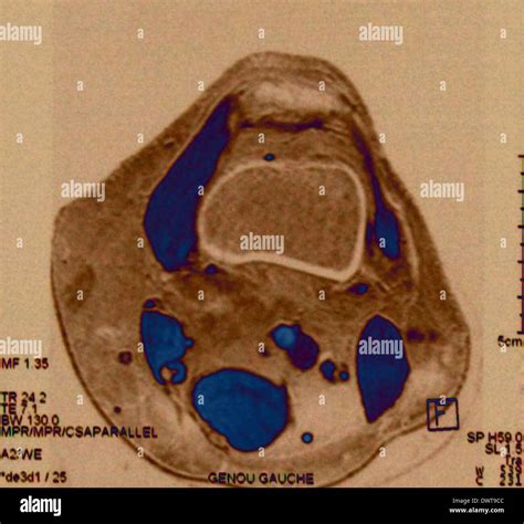 Resonancia Magn Tica De Rodilla Fotograf A De Stock Alamy