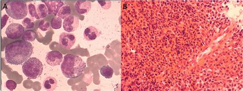 Frontiers Case Report Leukemia Cutis As The First Manifestation Of