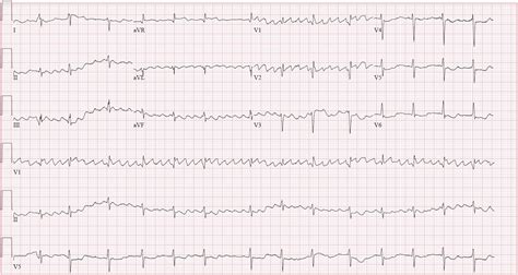 Precapillary Pulmonary Arterial Hypertension Despite Contrary Anchoring