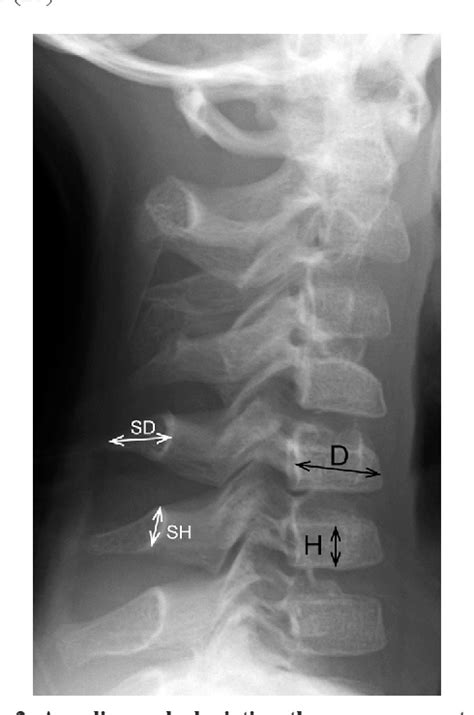 Figure 2 From Radiographic Characteristics Of The Hand And Cervical