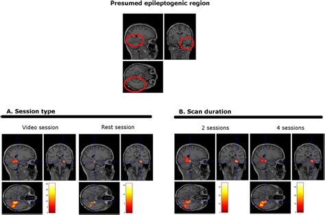 Example Of Ied Related Eeg Fmri Maps Patient With Epilepsy