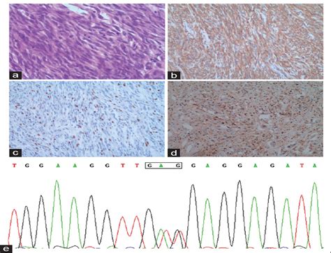 Gastrointestinal Stromal Tumors with KIT Mutation Coexisting ...