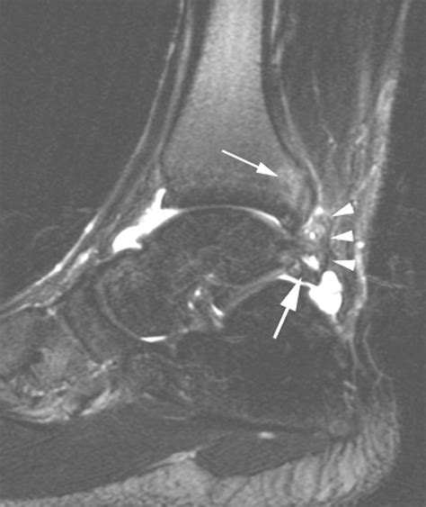 Posterior Ankle Impingement In Professional Soccer Players