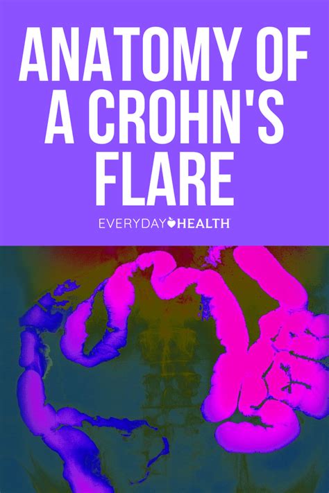 What is a crohn s disease flare up – Artofit