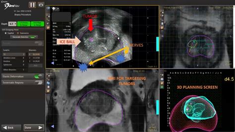 Focal Prostate Cancer Cryoablation Using Mr Us Fusion Guidance Uronav