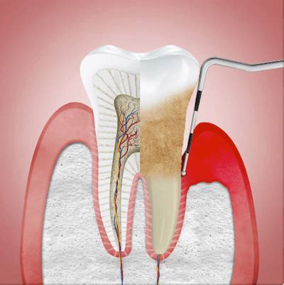 Tratamiento De La Enfermedad Periodontal Dr Ferrer