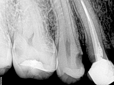 composite restoration smiles  roots