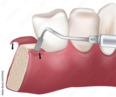 Mid Crestal Incision Used During Implant Bed Preparation Paracrestal