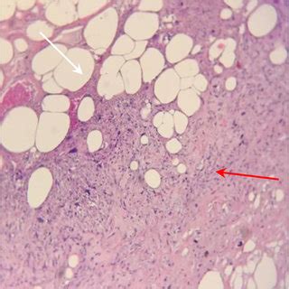 Core Biopsy Microscopy Well Differentiated Area Of Liposarcoma X