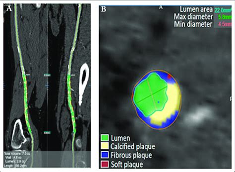 ct plaque tissue composition analysis  femoral artery plaque  cta