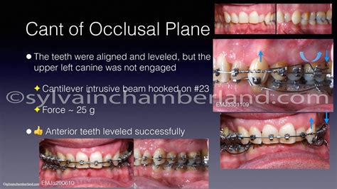 Occlusal Plane Inclination Dr Sylvain Chamberland Orthodontist