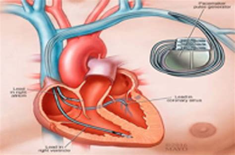 Cardiac Resynchronization Therapy Crt