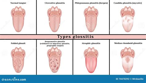 Types Glossitis. Inflammatory Disease Tongue Vector Illustration ...