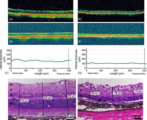 Comparison Of Optical Coherence Tomogram Oct With Histology Of A