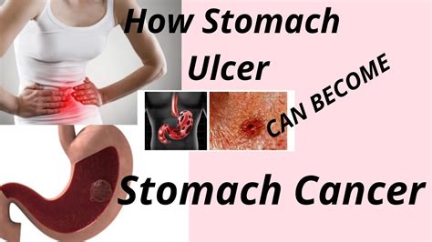 How Stomach Ulcer Can Turn To Stomach Cancer Youtube