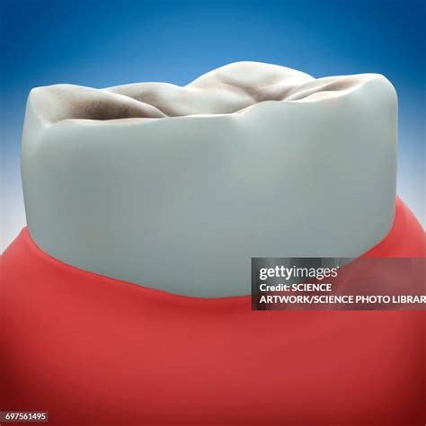 159 Molar Tooth Decay Stock Photos, High-Res Pictures, and Images ...