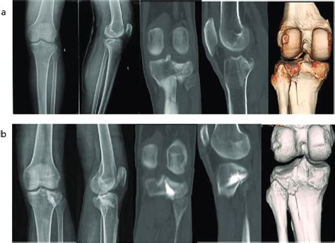 Preoperative A And Postoperative B Fluoroscopic Radiography And 3d Download Scientific