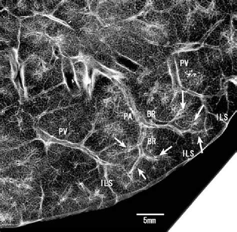 Figure 1 From Imaging Of Pulmonary Emphysema A Pictorial Review Semantic Scholar