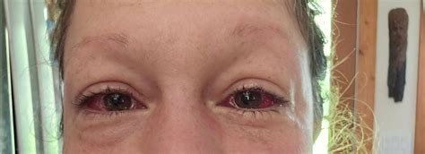 Strabismus Surgery And Torsional Correction In Both Eyes Day After Surgery R Strabismus