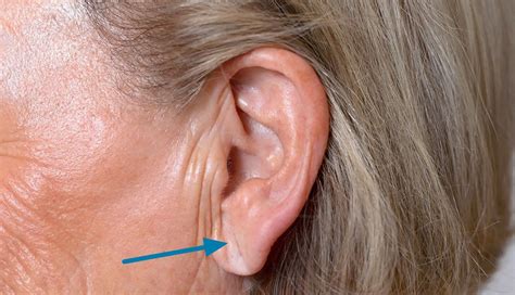 Earlobe Crease Diagonal Earlobe Crease And Heart Disease