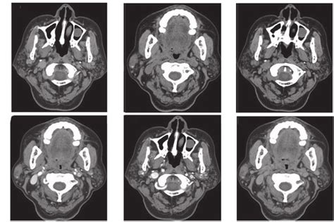 Ct Of A 68 Year Old Male Patient Showing The Bilateral Parotid Gland Download Scientific