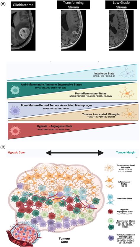 Microglia And Macrophages In Glioblastoma Landscapes And Treatment