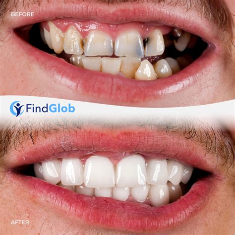 Before And After Findglob Provides The Best Results