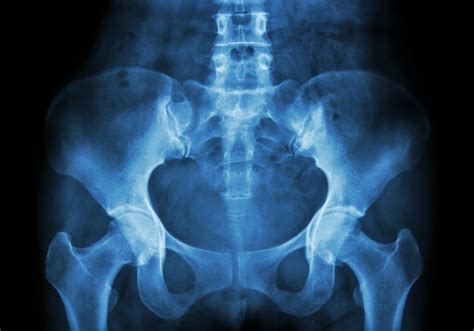 Premium Photo | Film x-ray of pelvis