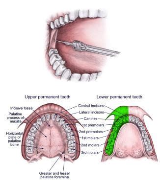 Seguro Tiempos antiguos Ser posterior superior alveolar nerve block ...