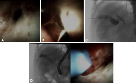 An Antegrade Approach To Transpapillary Gallbladder Drainage