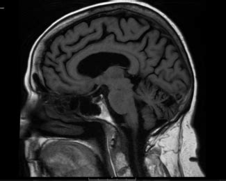 mri brain  contrast greater waterbury imaging center