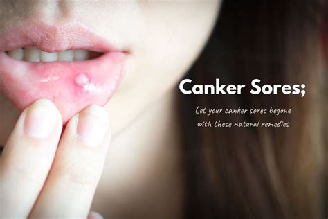 Natural Remedies To Cure Canker Sores Go Lifestyle Wiki