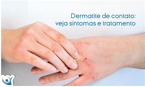 Dermatite de contato veja sintomas e tratamento Alergoclínica