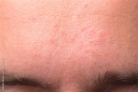 Eczema Forehead