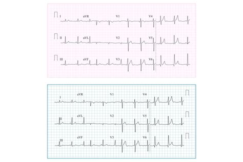 Heart Cardiogram Chart Vector Set Healthy Heart Rhythm 677536