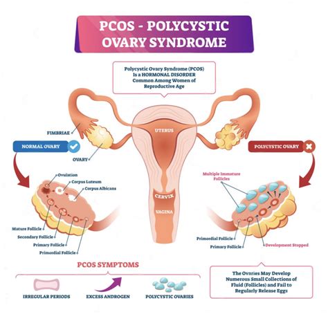 How Pcos Affects Fertility Mindandmom