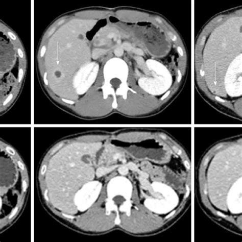 Contrast Enhanced Abdominal Computed Tomography Scan Showing Multiple