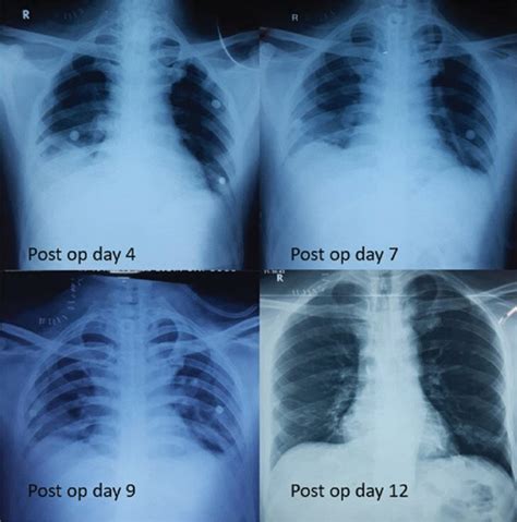 Serial Chest X Rays Of The Patientdays 47and 9 Are Portable Bedside