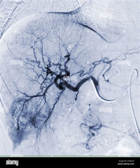 Transarterial Chemoembolization Tace Is A Medical Procedure Used To