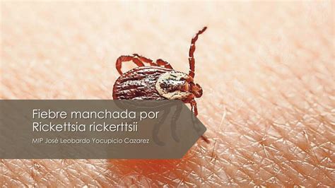 Fiebre Manchada Por Rickettsia Rickerttsii Jos Leobardo Yocupicio