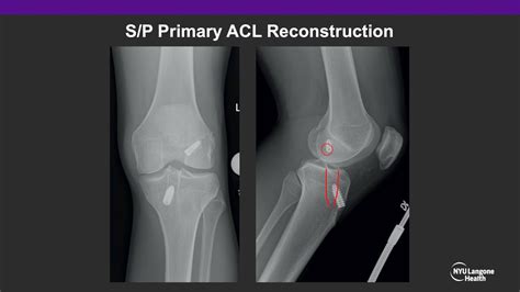 Revision Acl Reconstruction And Modified Lemaire All Reconstruction For