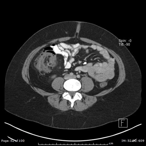 Colonic Intussusception Colonic Lipoma Image Radiopaedia Org