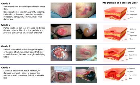 Pressure Area Assessment (Braden scale) - NMC OSCE - Patient Life Matters