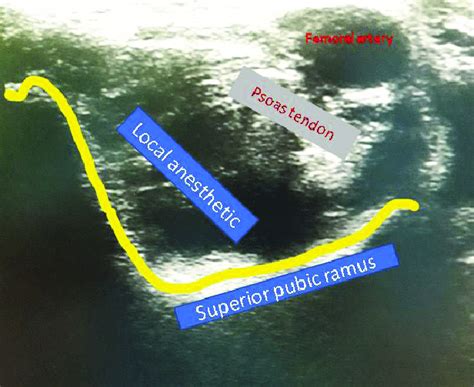 Ultrasound Image After Administration Of The Pericapsular Nerve Group