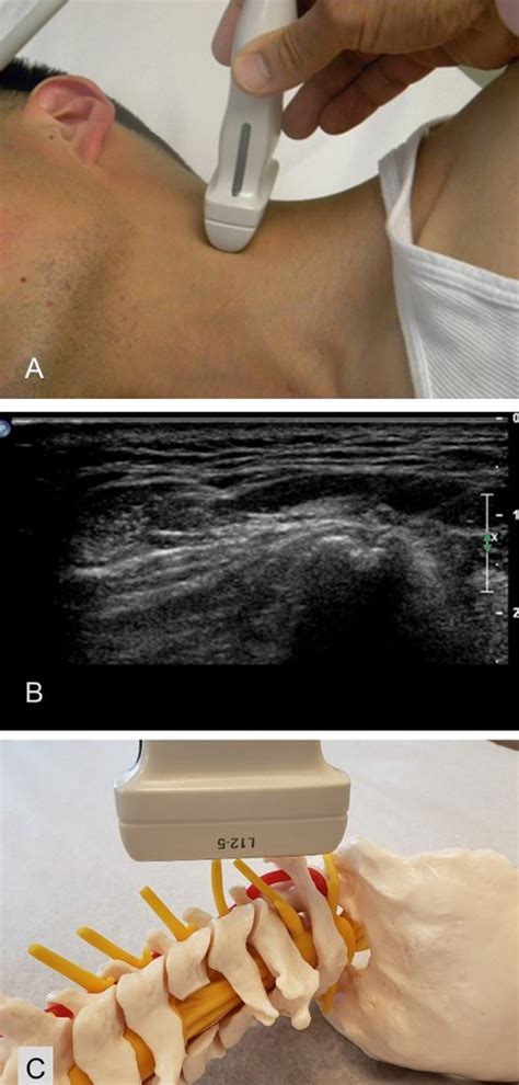 Swiss Ultrasound Center Uzr On Twitter Ultrasound Guided Cervical Facet Joint Injections